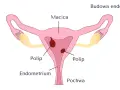 Ilustracja przedstawia budowę macicy z widocznymi polipami w endometrium.