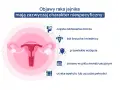 Objawy raka jajnika, które mogą być mylone z innymi dolegliwościami, to m.in. ból brzucha, wzdęcia, zmiany w cyklu menstruacyjnym.
