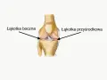 Ilustracja anatomiczna stawu kolanowego z zaznaczonymi łąkotkami: boczną i przyśrodkową.