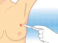 Ilustracja przedstawia biopsję piersi: dłoń w rękawiczce trzyma skalpel zbliżający się do piersi z widocznym guzem.