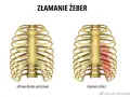 Dwie klatki piersiowe: zdrowa i z widocznymi złamaniami żeber zaznaczonymi na czerwono.