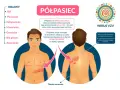 Ilustracja przedstawia objawy półpaśca na ciele mężczyzny i wirusa VZV.