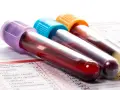 Trzy probówki z krwią, jedna z fioletową, druga z niebieską, trzecia z pomarańczową zakrętką, leżą na formularzu laboratoryjnym. Wyniki badań, w tym poziomy płytki krwi, czekają na analizę.