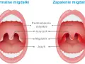 Porównanie budowy gardła: zdrowe migdałki po lewej, zapalone po prawej.