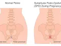 Ilustracja porównująca prawidłową miednicę z dysfunkcją spojenia łonowego podczas ciąży.