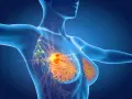 Anatomical illustration of a female torso showing breast tissue and lymph nodes, with a highlighted area indicating a potential issue.