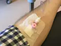 Ramię z wenflonem i plastrem, przygotowane do podania leku.