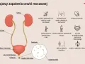 Ilustracja układu moczowego z nerkami, pęcherzem, cewką moczową i objawami zapalenia.
