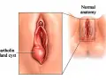 Powiększony gruczoł Bartholina po lewej, obok schematu prawidłowej anatomii.