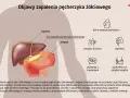 Ilustracja anatomiczna przedstawiająca wątrobę, pęcherzyk żółciowy i żołądek, z ikonami objawów zapalenia.