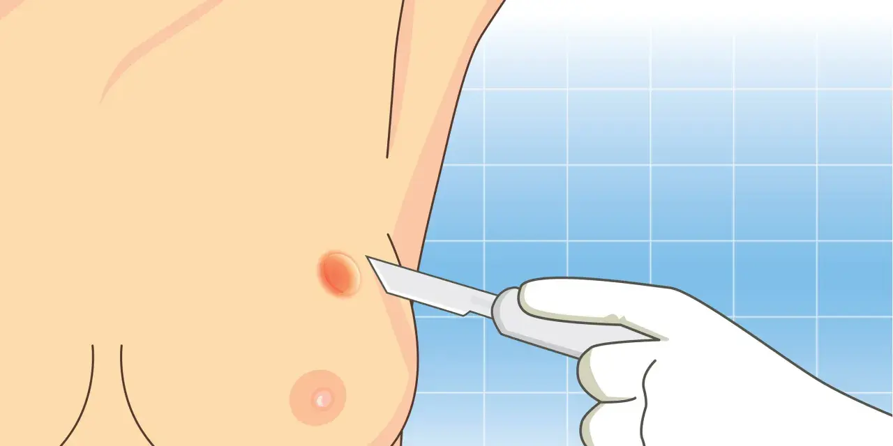 Ilustracja przedstawia biopsję piersi: dłoń w rękawiczce trzyma skalpel zbliżający się do piersi z widocznym guzem.