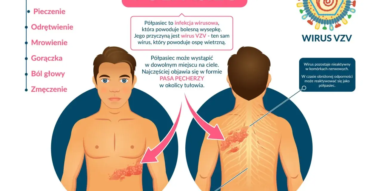 Ilustracja przedstawia objawy półpaśca na ciele mężczyzny i wirusa VZV.
