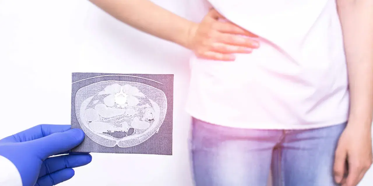 Lekarz w rękawiczce pokazuje tomografię jamy brzusznej osobie z bólem brzucha.