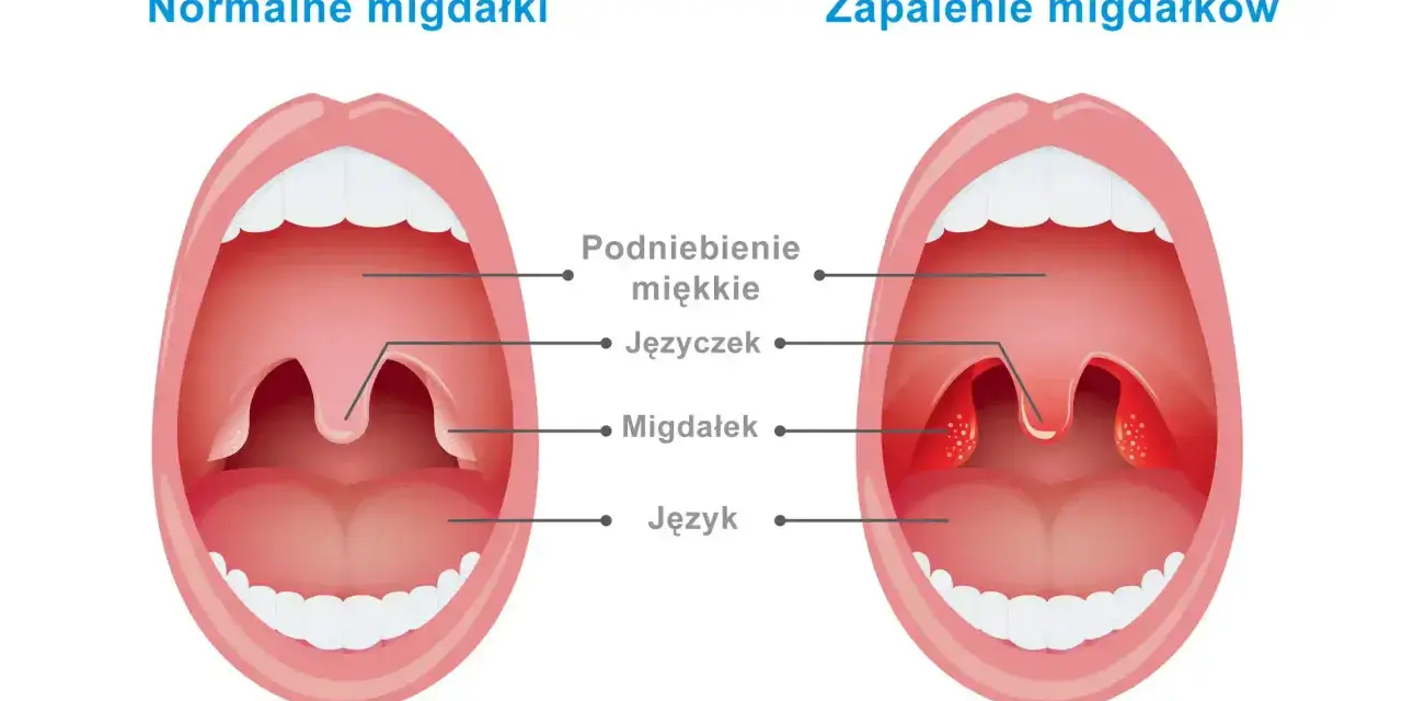 Porównanie budowy gardła: zdrowe migdałki po lewej, zapalone po prawej.
