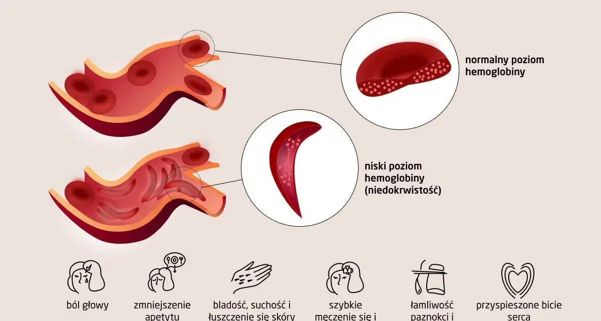 Ilustracja porównuje prawidłowy i niski poziom hemoglobiny, pokazując zdrowe krwinki i te o zmienionym kształcie. Objawy niskiej hemoglobiny to m.in. ból głowy.