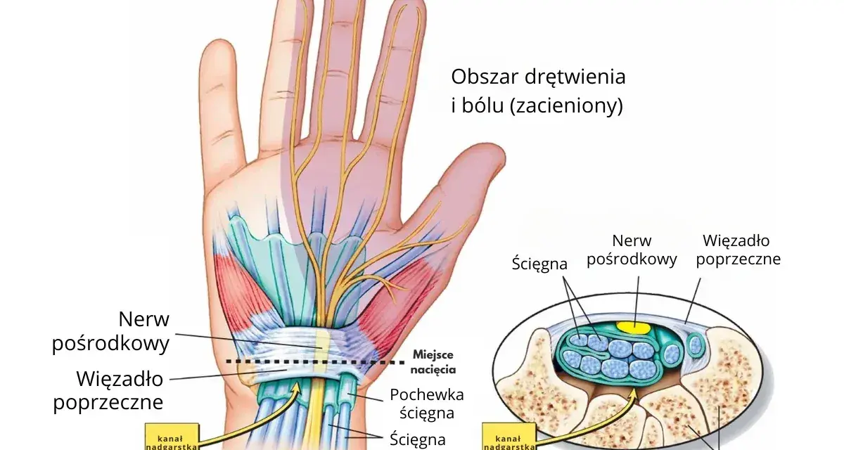 Ilustracja anatomiczna dłoni i nadgarstka z zaznaczonym nerwem pośrodkowym i więzadłem poprzecznym.