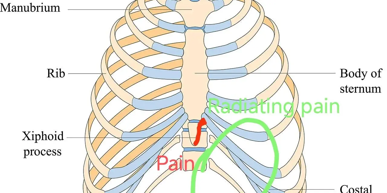 Anatomia klatki piersiowej z zaznaczonym wyrostkiem mieczykowatym i obszarem bólu.