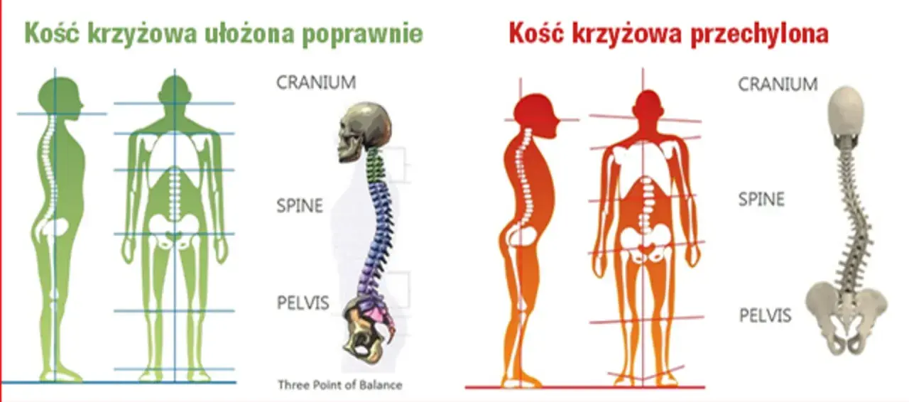 Prawidłowe ułożenie kości krzyżowej zapewnia stabilność kręgosłupa. Po prawej widać skrzywienie, gdzie kość krzyżowa jest przechylona.