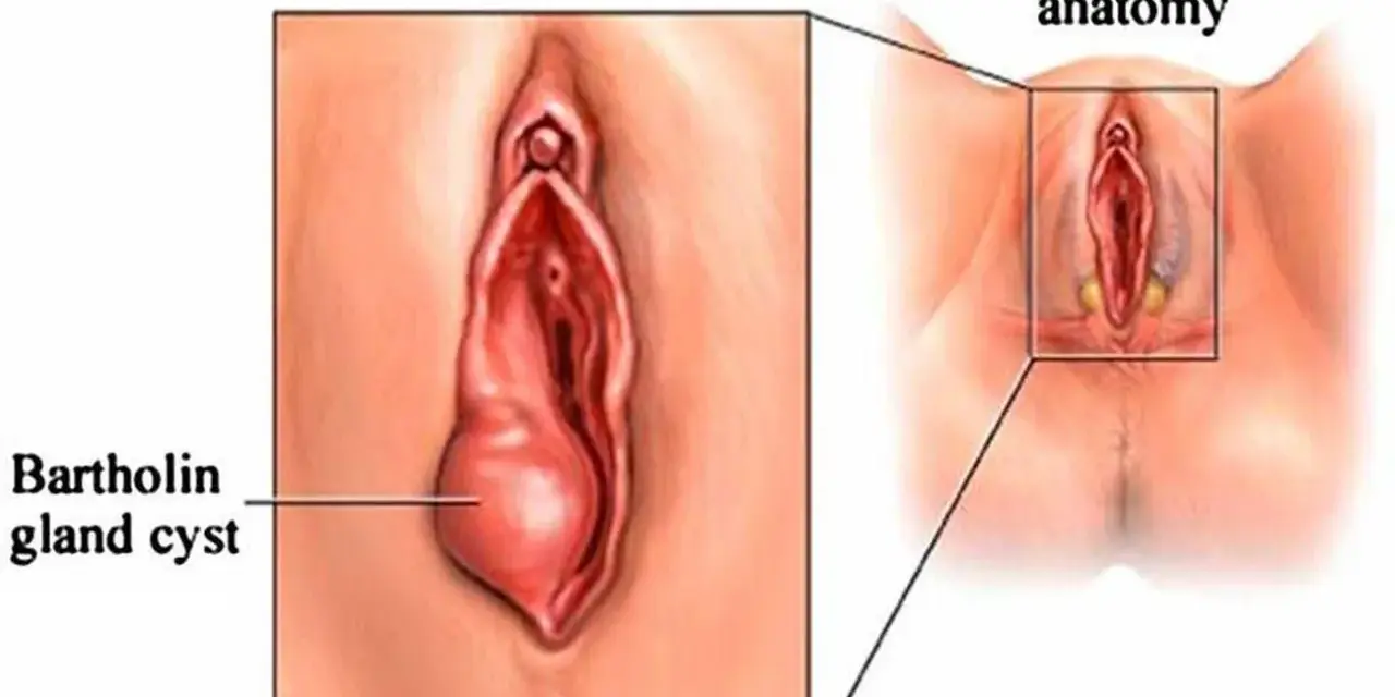 Powiększony gruczoł Bartholina po lewej, obok schematu prawidłowej anatomii.