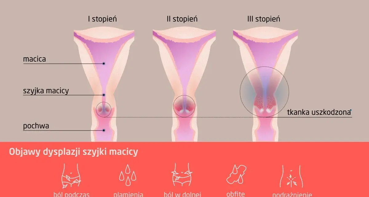 Ilustracja przedstawia trzy stadia dysplazji szyjki macicy: I, II i III stopień, z zaznaczonymi objawami.