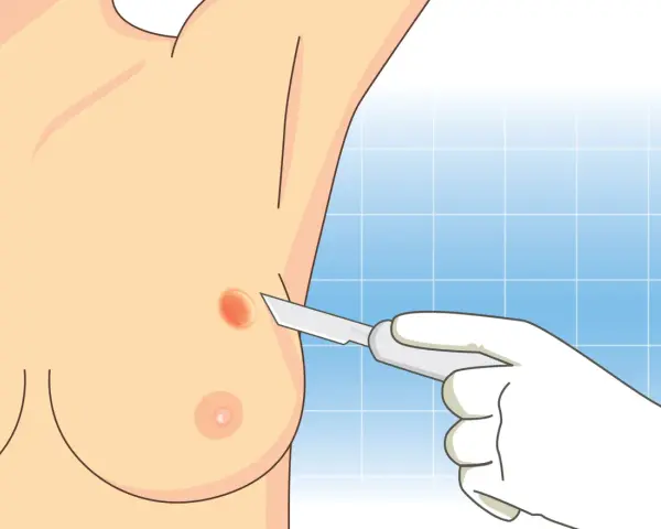 Ilustracja przedstawia biopsję piersi: dłoń w rękawiczce trzyma skalpel zbliżający się do piersi z widocznym guzem.