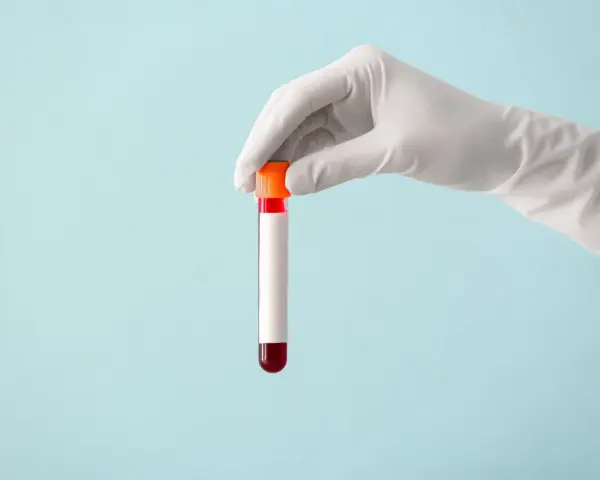 Ręka w białej rękawiczce trzyma probówkę z czerwoną próbką krwi, gotową do analizy, która może wykazać poziom immunoglobuliny.