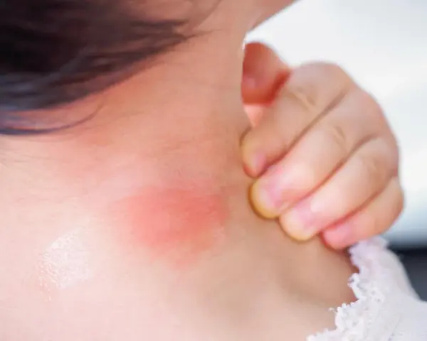 Czerwona wysypka na szyi dziecka, którą dziecko drapie.