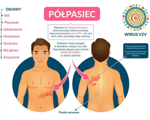 Ilustracja przedstawia objawy półpaśca na ciele mężczyzny i wirusa VZV.
