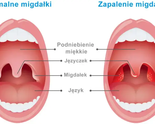 Porównanie budowy gardła: zdrowe migdałki po lewej, zapalone po prawej.