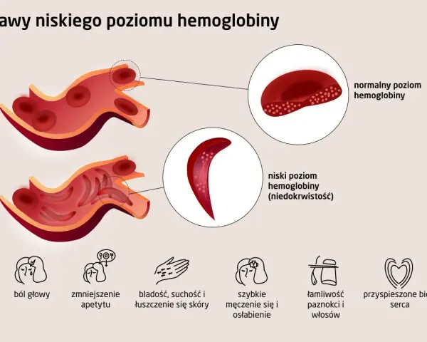 Ilustracja porównuje prawidłowy i niski poziom hemoglobiny, pokazując zdrowe krwinki i te o zmienionym kształcie. Objawy niskiej hemoglobiny to m.in. ból głowy.