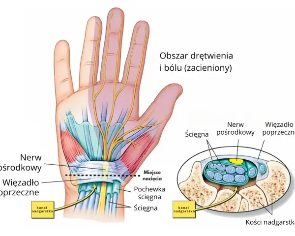 Ilustracja anatomiczna dłoni i nadgarstka z zaznaczonym nerwem pośrodkowym i więzadłem poprzecznym.