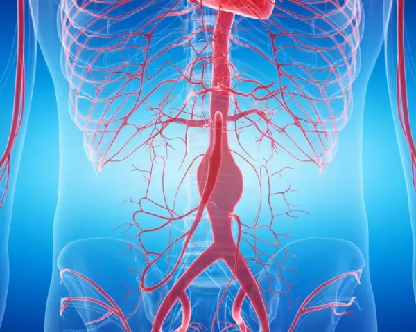 Anatomia aorty brzusznej z widocznym tętniakiem.