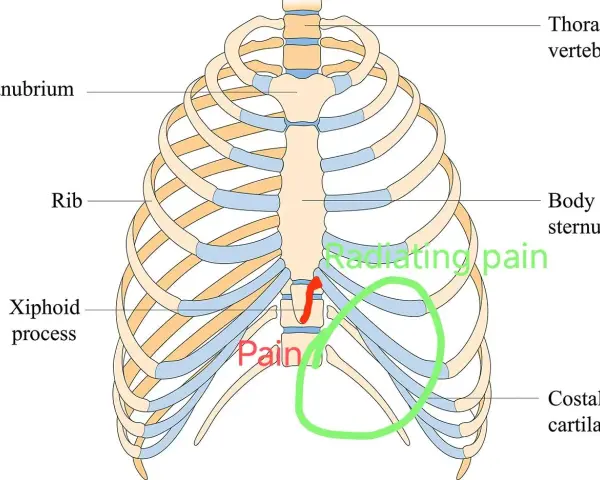Anatomia klatki piersiowej z zaznaczonym wyrostkiem mieczykowatym i obszarem bólu.