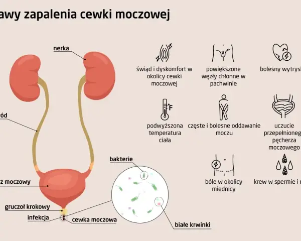Ilustracja układu moczowego z nerkami, pęcherzem, cewką moczową i objawami zapalenia.