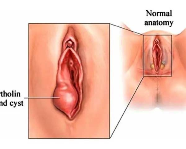 Powiększony gruczoł Bartholina po lewej, obok schematu prawidłowej anatomii.