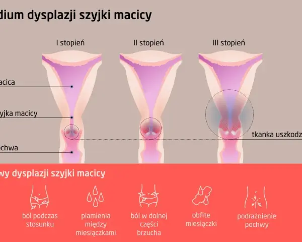 Ilustracja przedstawia trzy stadia dysplazji szyjki macicy: I, II i III stopień, z zaznaczonymi objawami.
