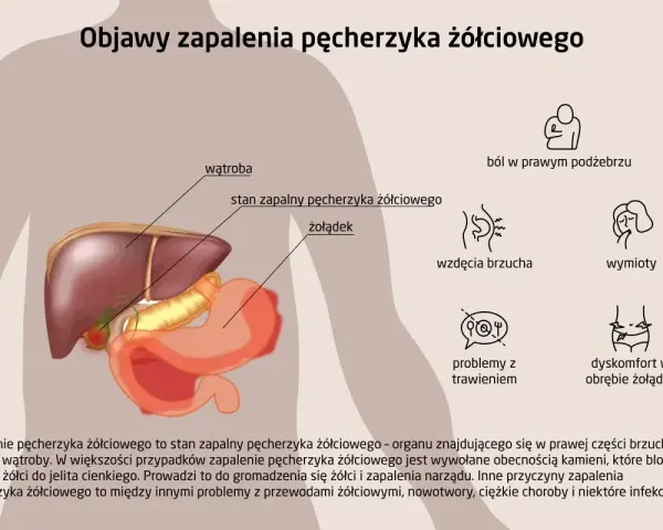 Ilustracja anatomiczna przedstawiająca wątrobę, pęcherzyk żółciowy i żołądek, z ikonami objawów zapalenia.
