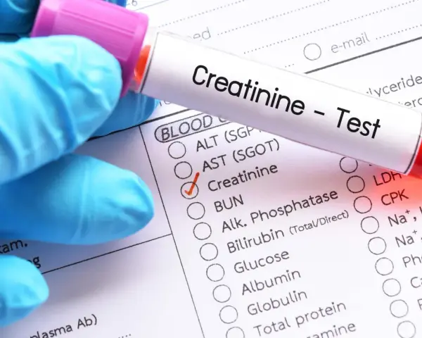 Rękawiczka w niebieskiej rękawiczce trzyma probówkę z napisem "Creatinine - Test". Zaznaczono pole "Creatinine", sugerując niski poziom kreatyniny.