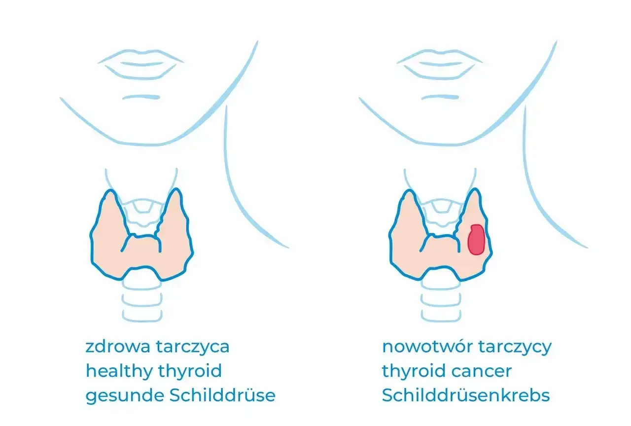 Porównanie zdrowej tarczycy z nowotworem. Po prawej stronie widoczna zmiana, która może wpływać na poziom kalcytoniny.