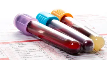 Trzy probówki z krwią, jedna z fioletową, druga z niebieską, trzecia z pomarańczową zakrętką, leżą na formularzu laboratoryjnym. Wyniki badań, w tym poziomy płytki krwi, czekają na analizę.