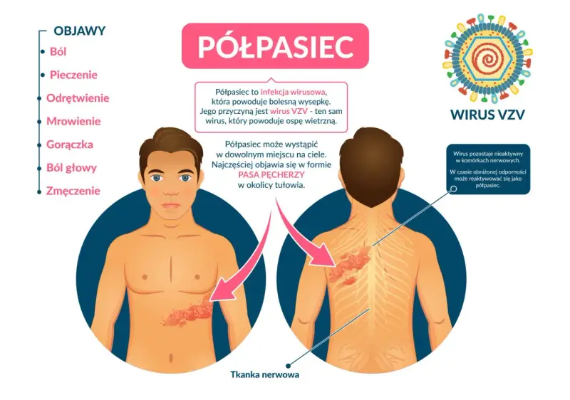 Ilustracja przedstawia objawy półpaśca na ciele mężczyzny i wirusa VZV.