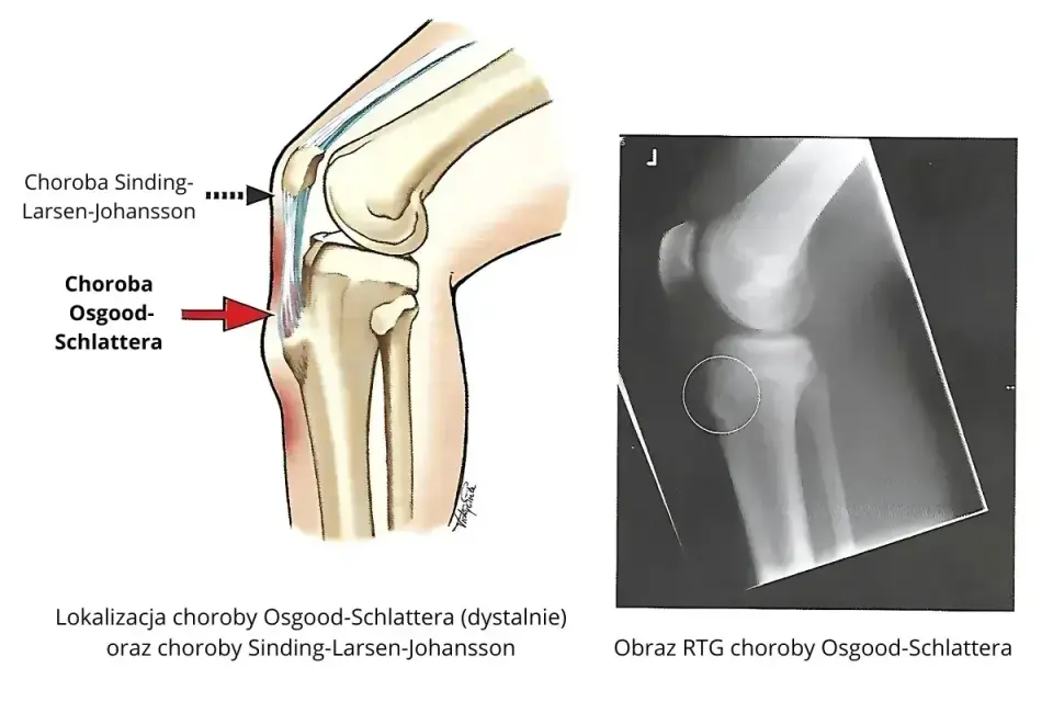 Ilustracja anatomiczna i RTG kolana pokazujące lokalizację choroby Osgood-Schlattera.